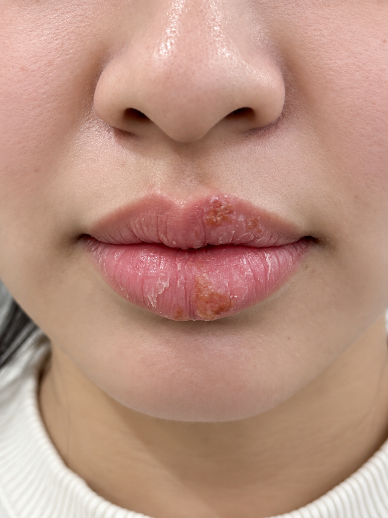 Blog clinical close up of chapped lips